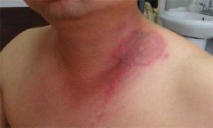 隱翅蟲皮炎的護理方法，隱翅蟲皮炎用什么藥？